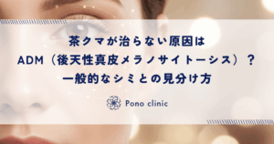 茶クマが治らない原因はADM（後天性真皮メラノサイトーシス）？一般的なシミとの見分け方
